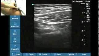 Ultrasound anatomy of the femoral nerve [upl. by Banebrudge]