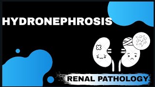 HYDRONEPHROSIS  Renal pathology   Med Bees [upl. by Sherrard]