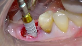 Immediate Implant placement with Versah® Burs  Mandibular 1st Molar [upl. by Ecirad]