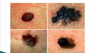 Cancerous moles and warts [upl. by Loralee359]