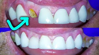 Broken Front Tooth Repair By A Dentist How to Fix a Crown Fractured at Gumline [upl. by Richela]