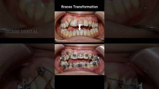 Braces transformation  open bite amp crooked teeth braces dentist orthodontist dental [upl. by Aseel]