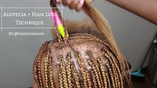 NEW TECHNIQUE ALOPECIA  HAIR LOSS BOX BRAIDS  IRENESBRAIDS [upl. by Kennith]