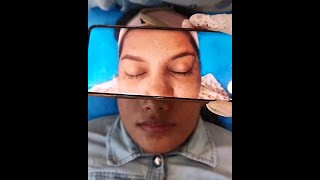 Microblading Eyebrows Treatment Before amp After DrAesthetix Clinic Chennai Dr Hemamalini Rajinikanth [upl. by Neeham89]