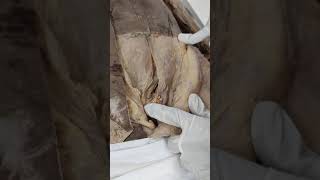 Dissection of Inguinal canal [upl. by Lotte635]