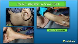 HenochSchonlein PurpuraHSP  Clinical features  Pathophysiology  Diagnosis and Treatment [upl. by Repooc459]