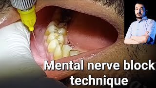 Local Anesthesia Mental Nerve block technique Mandibular Anesthesia Techniques dentistry [upl. by Nytsirc]