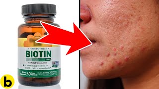 7 Serious Side Effects Of Biotin [upl. by Emearg]