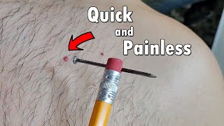 How to Remove Red Skin Dots at Home \\ Cherry Angioma Removal [upl. by Annehcu]