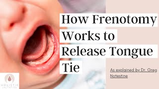 How Frenotomy Works to Release Tongue Tie [upl. by Kaasi]