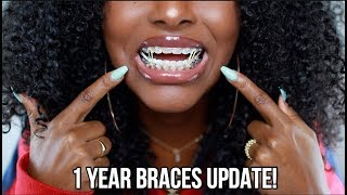 1 YEAR BRACES UPDATE  UNDERBITE JAW SURGERY CANCELLED [upl. by Einoj695]