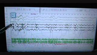 Sleep Study Scoring on Person with Severe Sleep Apnea and snoring Polysomnograph [upl. by Notsuoh]