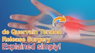 De Quervain Tendon Release Surgery  Explained [upl. by Cobbie]