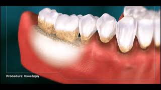 Osseous Recontouring Surgery [upl. by Anerroc]