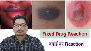 दवाई का Reaction  Fixed Drug Reaction  Paracetamol Ciprofloxacin Metronidazole Ornidazole PCM [upl. by Ulda728]