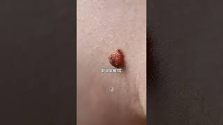 Skin Tags And Your Diet [upl. by Alonso]