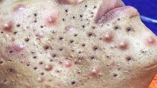 Big Cystic Acne Blackheads Extraction Blackheads amp Milia Whiteheads Removal Pimple Popping  5743 [upl. by Odessa350]