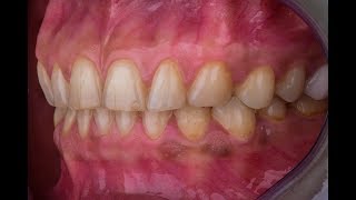 Dental Photography Easy Editing  تعديل صور الاسنان [upl. by Woodie]