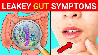 Leaky Gut  10 Signs and Symptoms of Leaky Gut Syndrome   Gut Health   Leaky Gut Symptoms [upl. by Rehpotsrik]