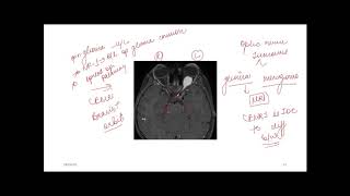 Glioma vs Meningioma [upl. by Niledam]