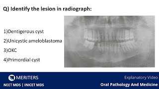 NEET MDS  INICET  Oral Pathology and Oral Medicine  MDS Prep Videos  MERITERS [upl. by Camile]