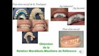 Relation Mandibulo Maxillaire Référence en Prothèse wmv [upl. by Tinaret]