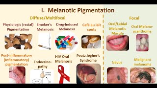 9 Wrap up of melanotic pigmentations [upl. by Runck726]