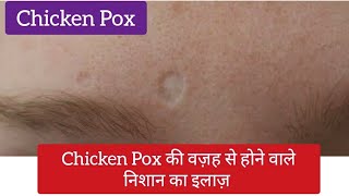 Chicken Pox की वज़ह से होने वाले निशान का इलाज़  Treatment of pigmentation amp Scars due to Chicken Pox [upl. by Martin957]