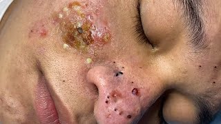 Big Cystic Acne Blackheads Extraction Blackheads amp Milia Whiteheads Removal Pimple Popping  1428 [upl. by Purvis862]