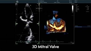 〖Echocardiography〗 The Mitral Valve in 3D  TTE 🫀 [upl. by Enamrej228]