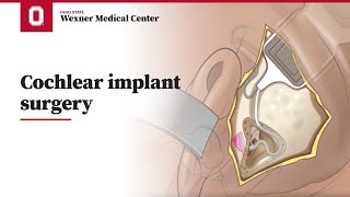 Cochlear implant surgery  Ohio State Medical Center [upl. by Novled309]