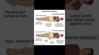 Decorticate posturing and Decerebrate posturing  important for bpt👀☠️📝 [upl. by Fennelly]