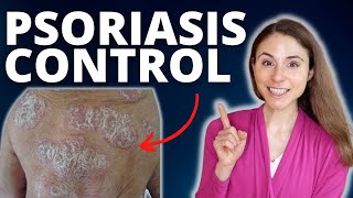 TOP 5 TIPS TO CONTROL PSORIASIS FLARES 😊 DERMATOLOGIST DrDrayzday [upl. by Sayed164]