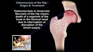 Osteonecrosis Of The Hip Stages amp Treatment  Everything You Need To Know  Dr Nabil [upl. by Hortensia798]