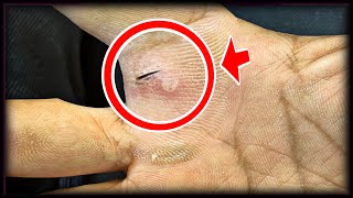 ASMR BARBER Removal of ingrown hair in my Hend ingrown hair removal [upl. by Holms]