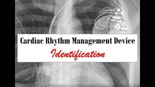 Cardiac Rhythm Management Device Identification [upl. by Daub208]