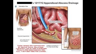 Appendicular lump amp abscess in bangla [upl. by Enegue]