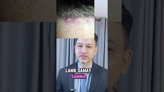 scalppimples folliculitis pimples acne dandruff dandrufftreatment [upl. by Fontes635]