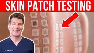 ALLERGY TESTING Doctor explains the Skin Patch Test [upl. by Ira]