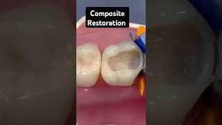 Composite Restoration Maxillary 1st molar Class 2 cavity youtube music thirdmolars molars [upl. by Syramad278]