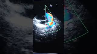 Patent Ductus Arteriosus ECHOCARDIOGRAM cardiacanatomy [upl. by Cati]