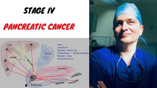 Pancreatic Cancer Stage 4 [upl. by Danaher]