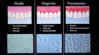 Health Gingivitis Periodontitis Mark Bonner dmd [upl. by Helm]