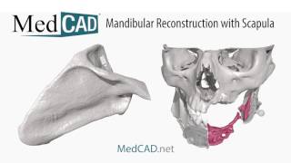 Mandibular Reconstruction with Scapula and PatientSpecific Guides [upl. by Aggarwal388]