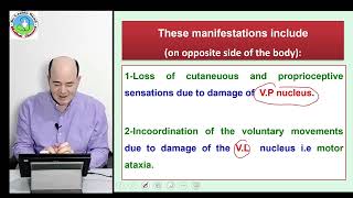 Thalamic syndrome [upl. by Hnoj]