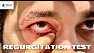 Regurgitation Test Lacrimal System Examination [upl. by Sokairyk]