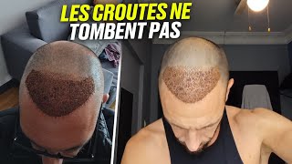 🟢J10 ça tombent pas  Quand Comment faire pour enlever retirer les croûtes greffe cheveux   DHI [upl. by Dorelle897]