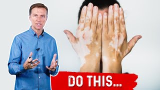 Vitiligo Do These 3 Things [upl. by Dyer925]