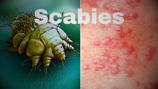 SCABIES Causes Signs and Symptoms What Diagnosis and Treatment to do  SCABIES  RD LifeStyle Vlogs [upl. by Billat]