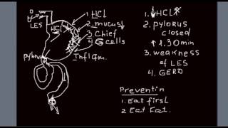 GERD Acid Reflux could be due to wine tequila rum whisky brandy Explained [upl. by Shelman276]